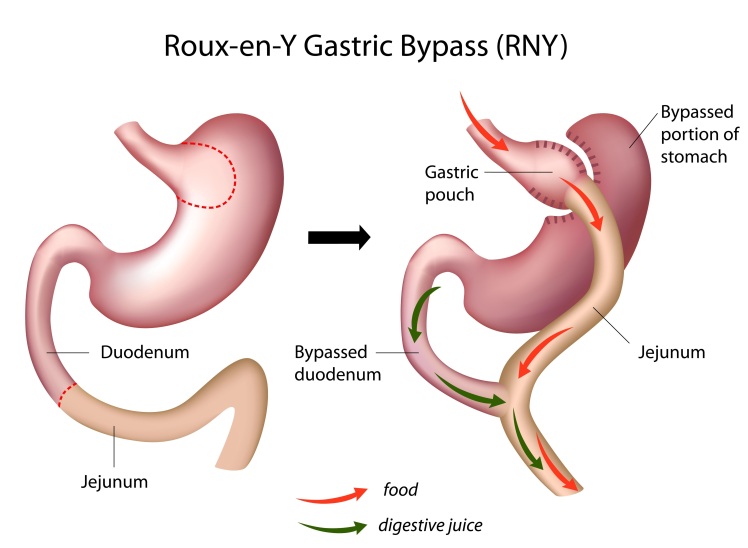 Laparoscopic-Gastric-Bypass-ReY